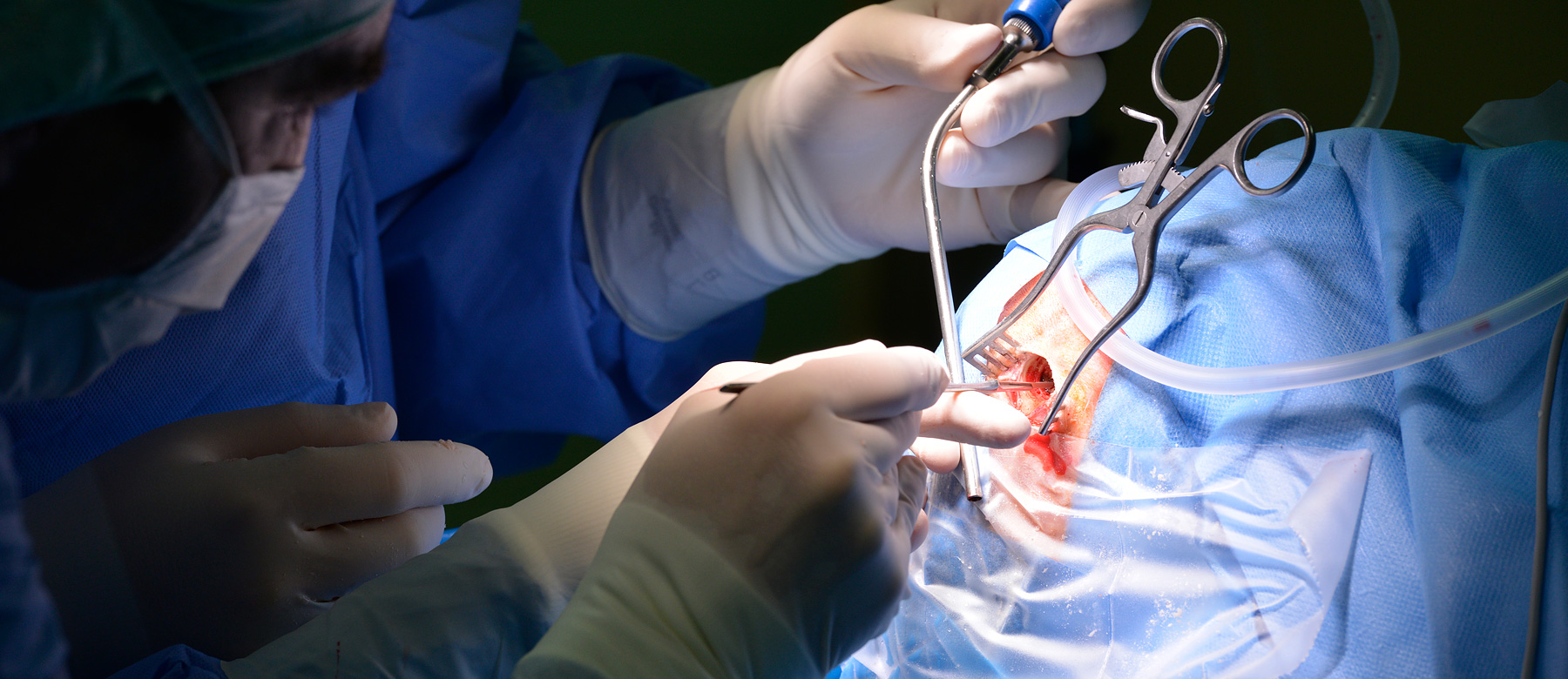 Ärzte der Abteilung für Neurochirurgie öffnen während der Operation den Schädel..